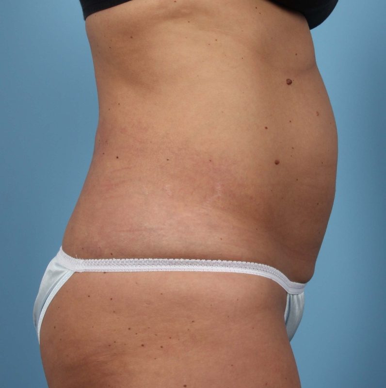 Getting Rid of Fat Forever