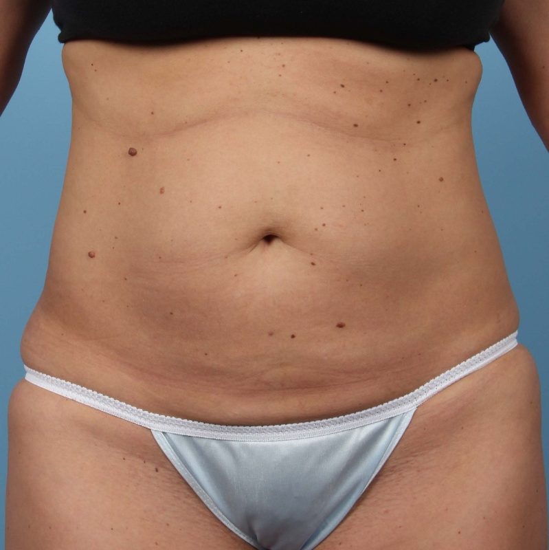 Getting Rid of Fat Forever
