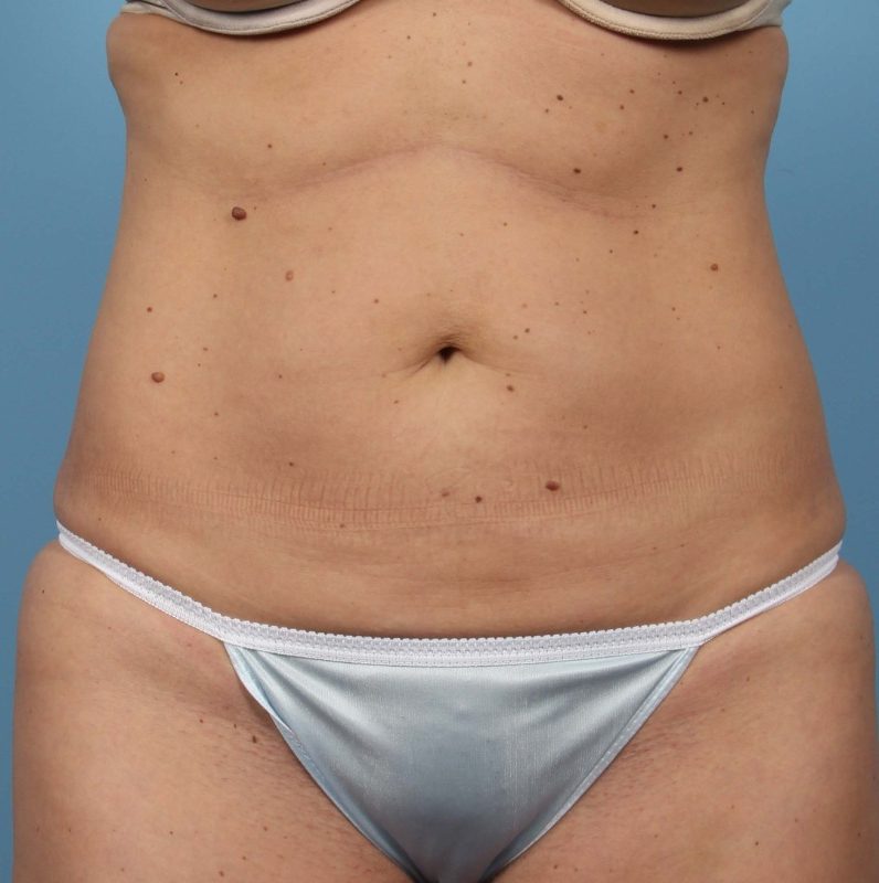 Getting Rid of Fat Forever