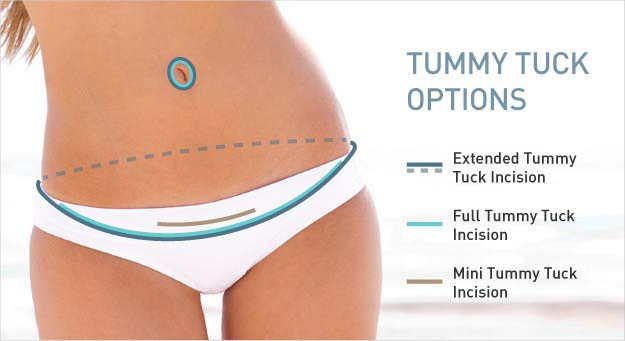 Tummy Tuck 