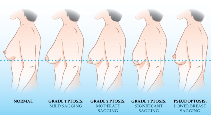 breast lift