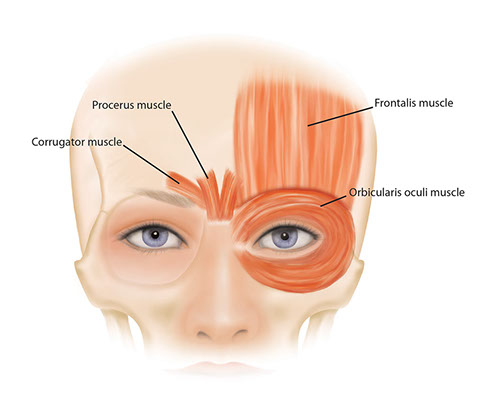 Botox Brow Lift